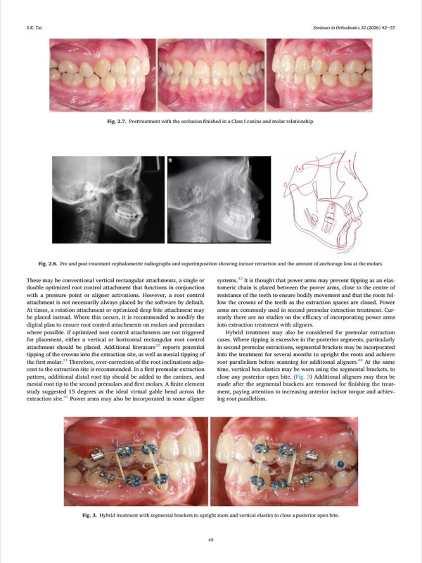Posttreatment & cephalo
